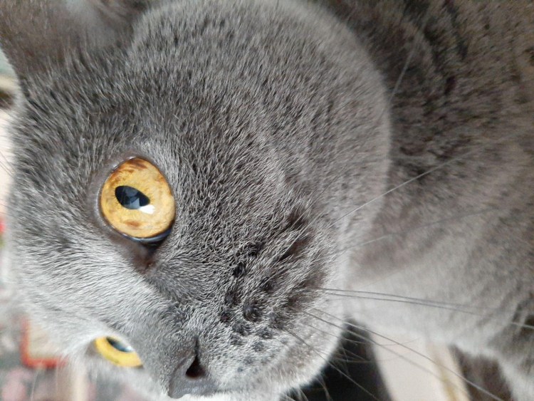 Увеальная меланома глаза