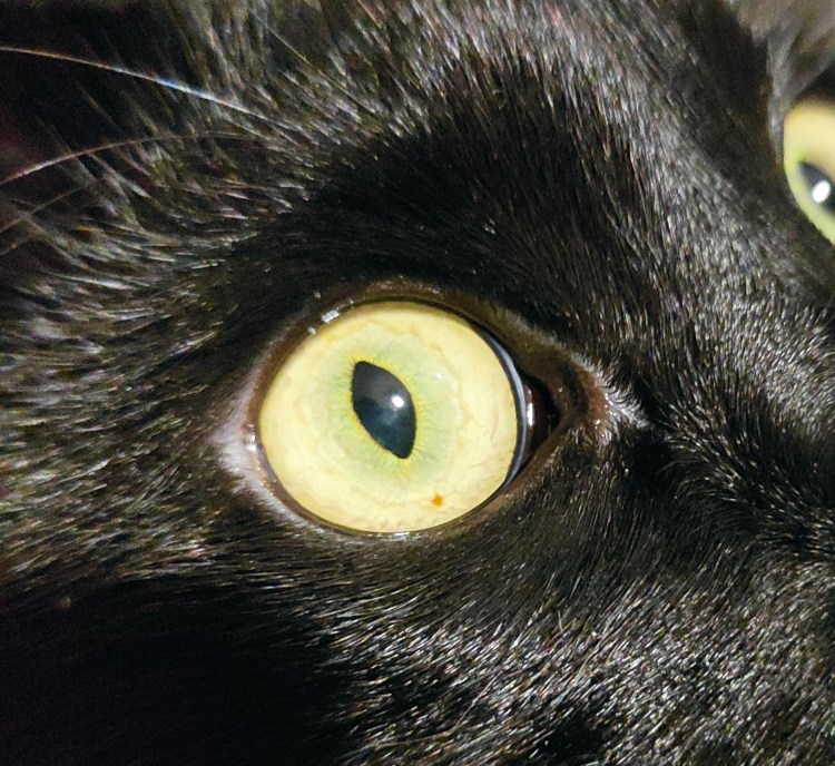 Диффузная меланома Радужки