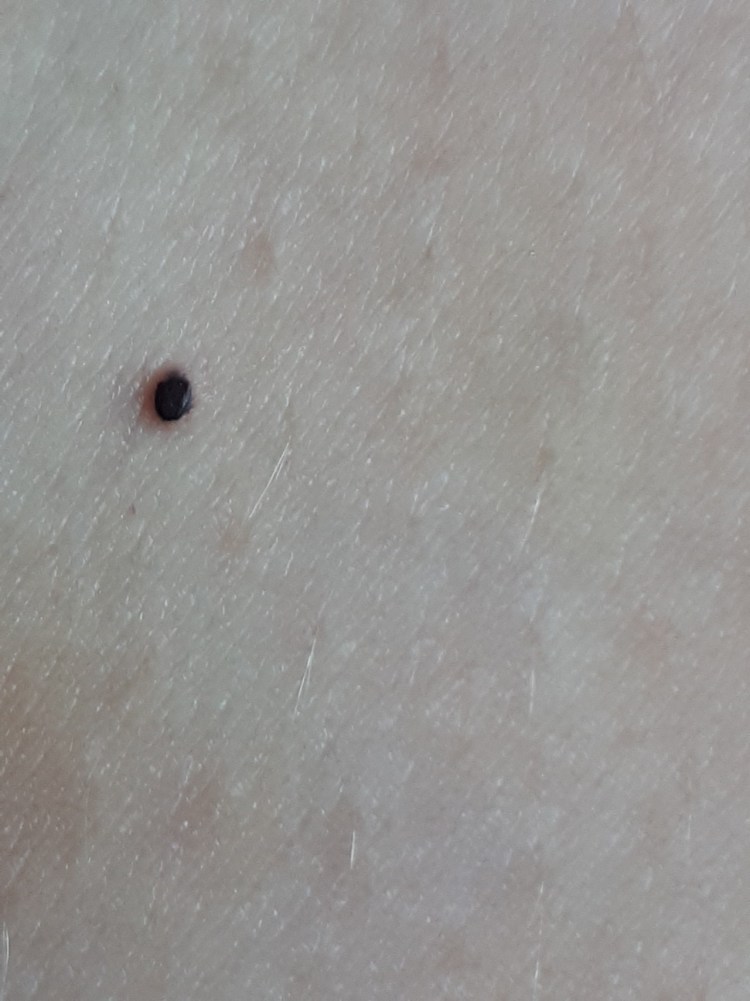 Малигнизированная меланома