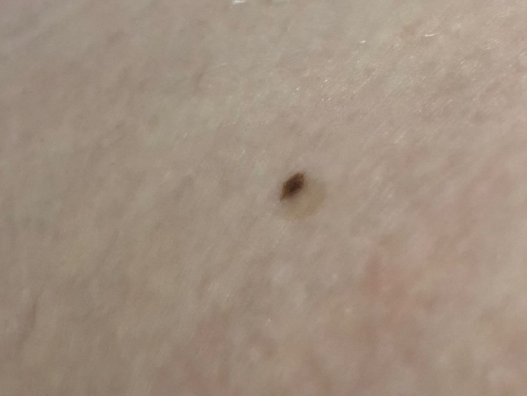 Блошиный аллергический дерматит