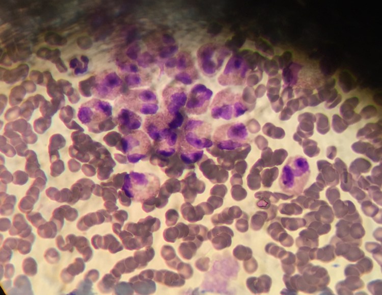 Эозинофильная гранулема и аллергия