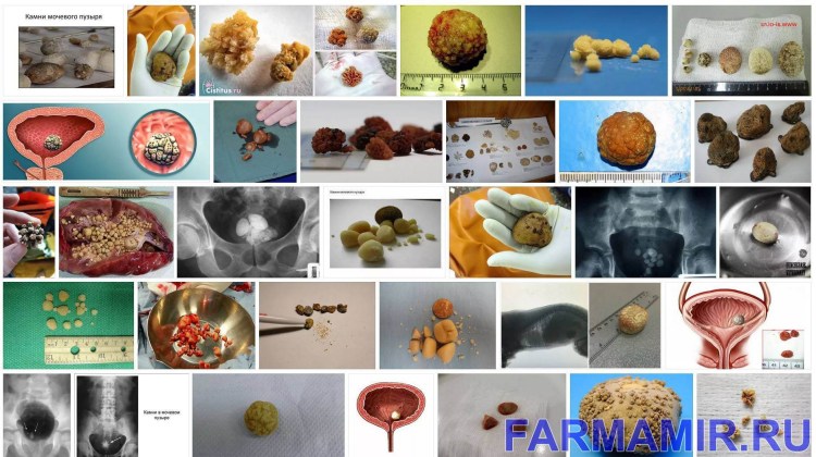 Струвитные камни в мочевом пузыре