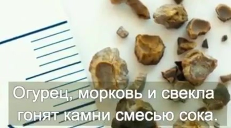 Почечные камни оксалаты