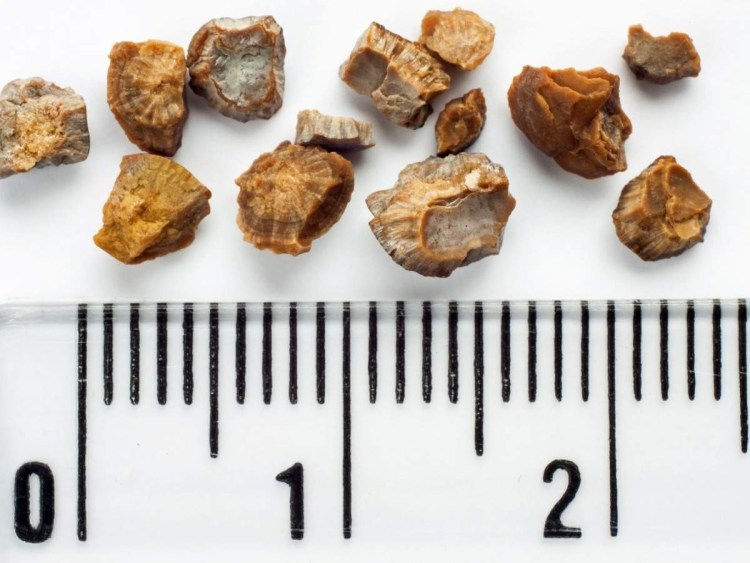 Струвиты камни в мочевом пузыре