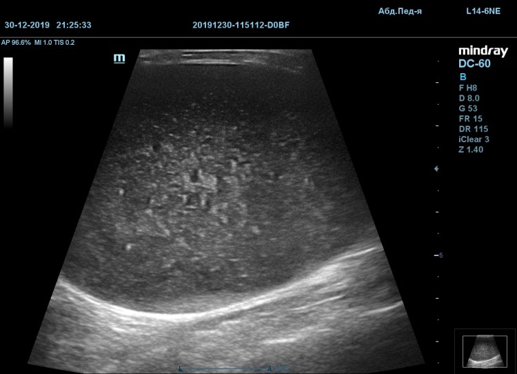 Камень оксалаты в мочевом пузыре