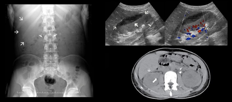 Мочекаменная болезнь расположение камней