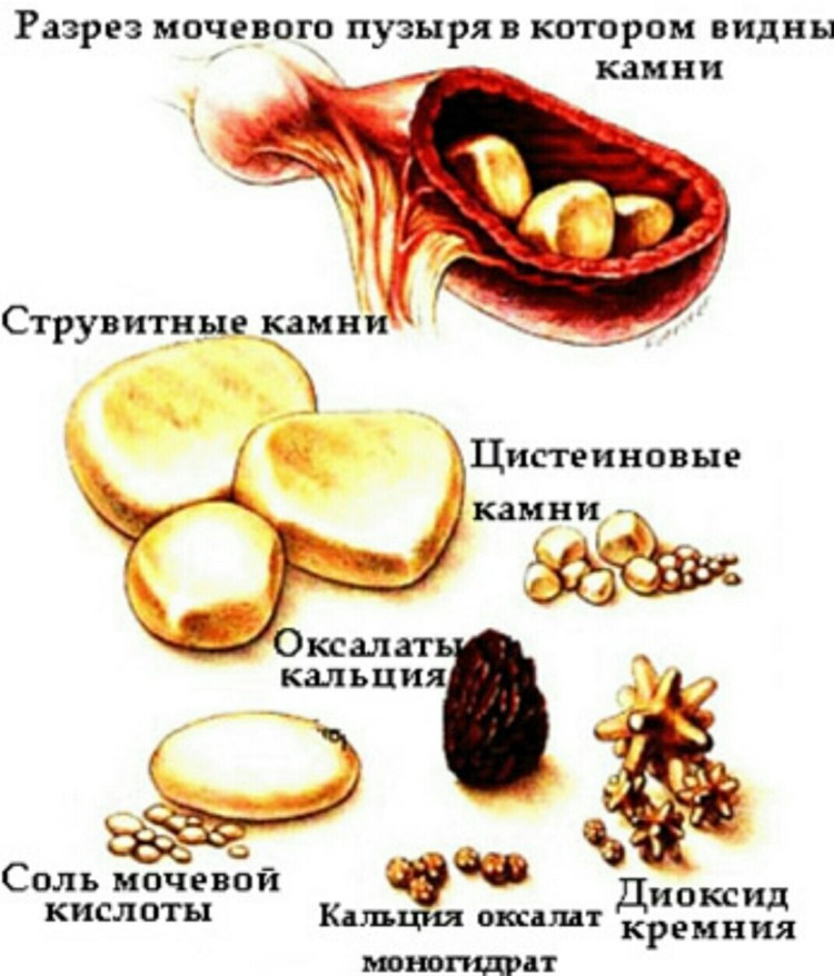 Мочекаменная болезнь цистиновые камни