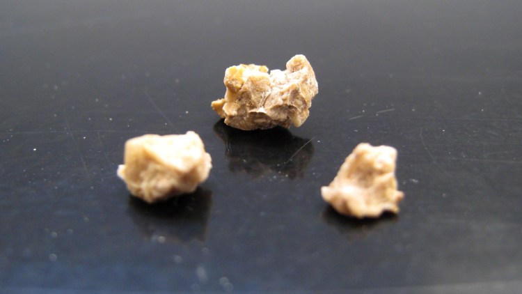 Песок в моче