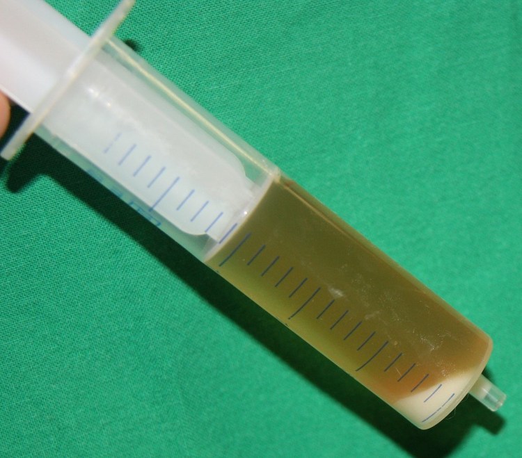 Камень в мочевом пузыре рентгенограмма