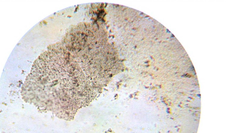 Кальций оксалатные камни