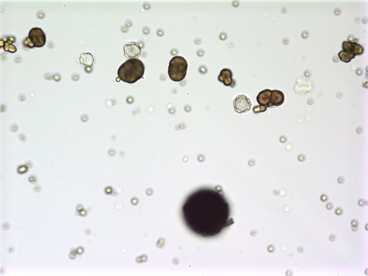 Оксалаты камни