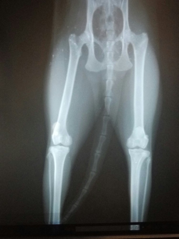 Ахондроплазия рентген