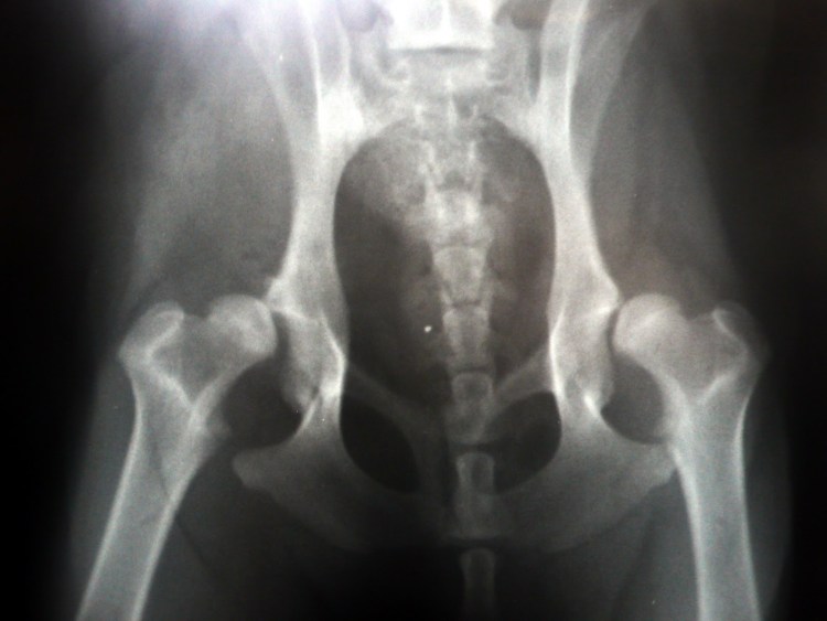 Дисплазия тазобедренного сустава вывих подвывих