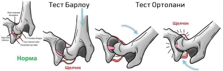 Пателлофеморальный артроз коленного сустава рентген
