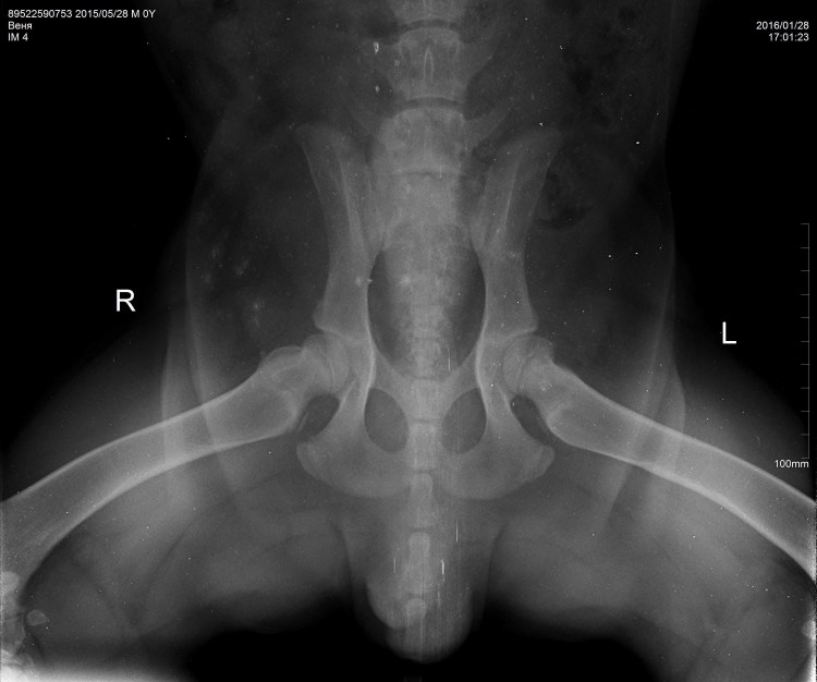Дисплазия тазобедренных суставов