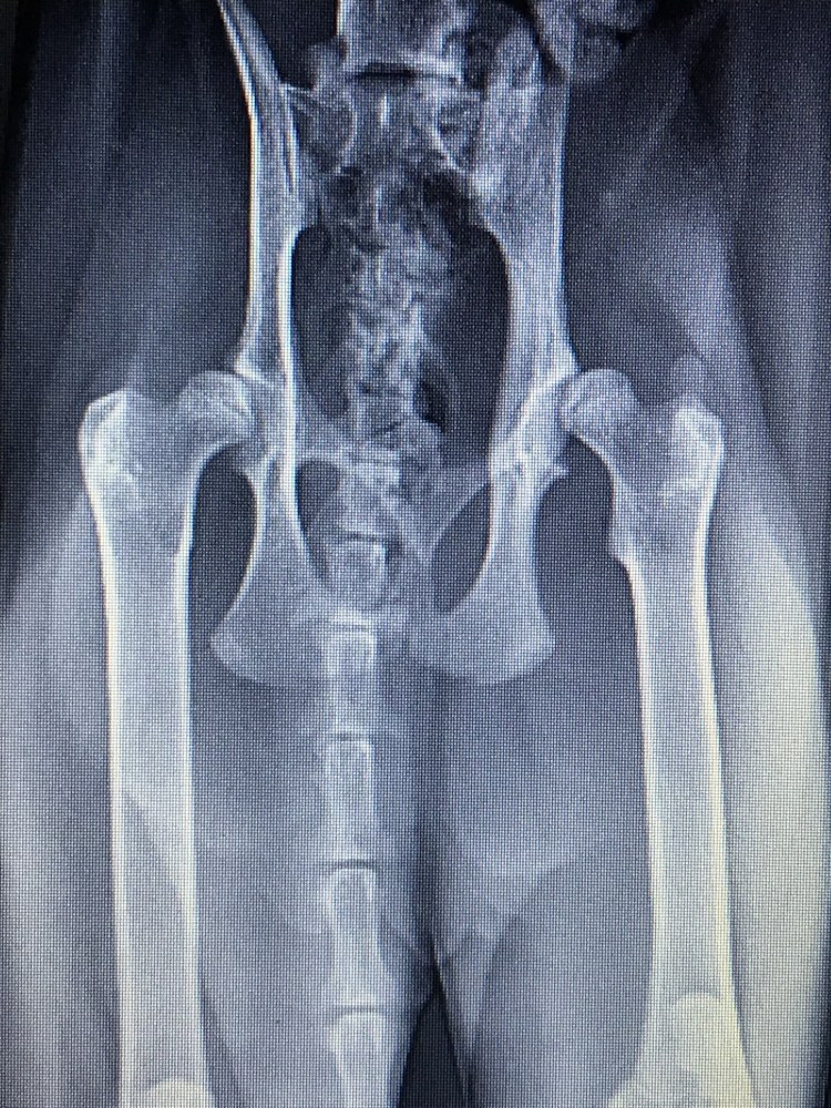 Дисплазия суставов у людей