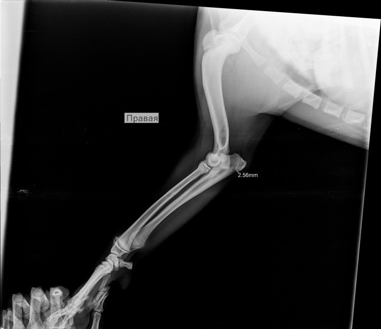 Дисплазия подвывих тазобедренного сустава