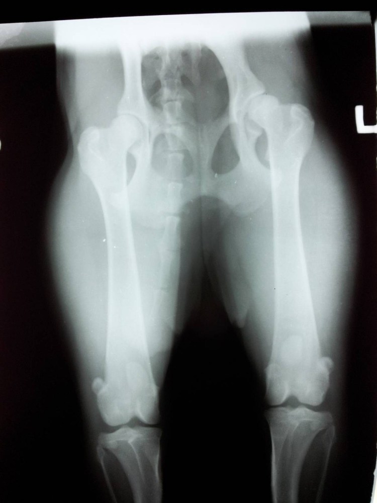 Аплазия ядер окостенения