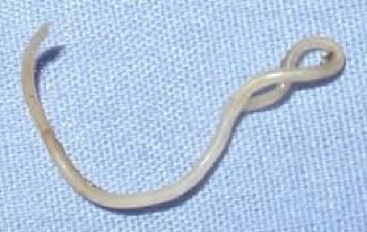 Имагинальный токсокароз