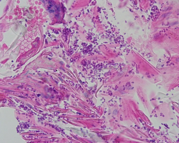 Разноцветный лишай. Возбудитель Malassezia FURFUR.