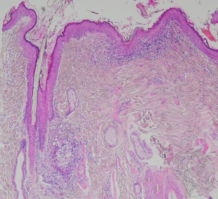 Pityrosporum ovale и Pityrosporum orbiculare
