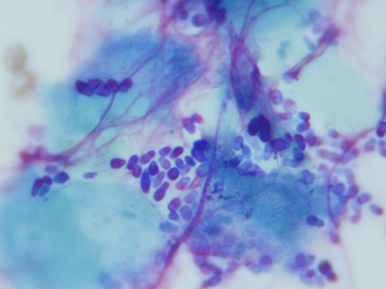 Мезотелиома цитология