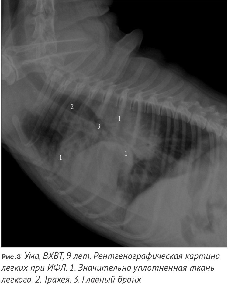 Идиопатический фиброз легких рентген