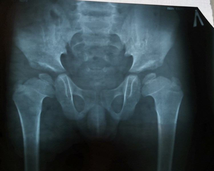 Гипертрофическая остеохондродисплазия