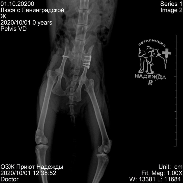 Дисплазия тазобедренных суставов у взрослых