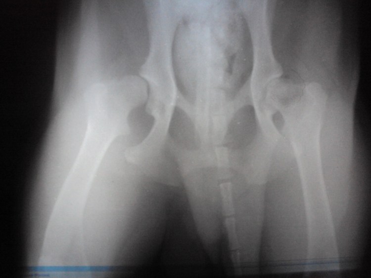 Остаточная дисплазия тазобедренных суставов у детей