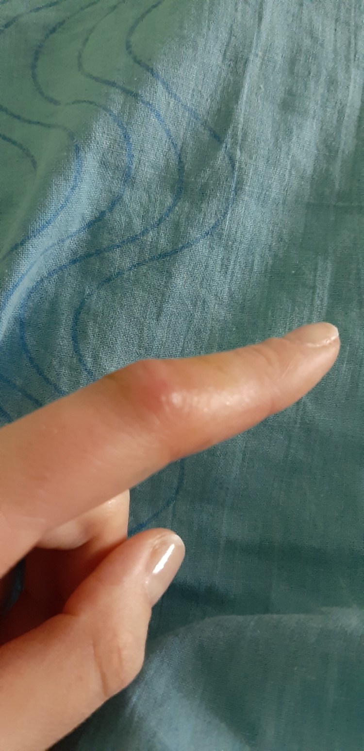 Стригущий лишай (дерматофитоз