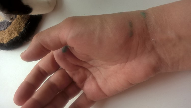 При укусе собаки необходимо