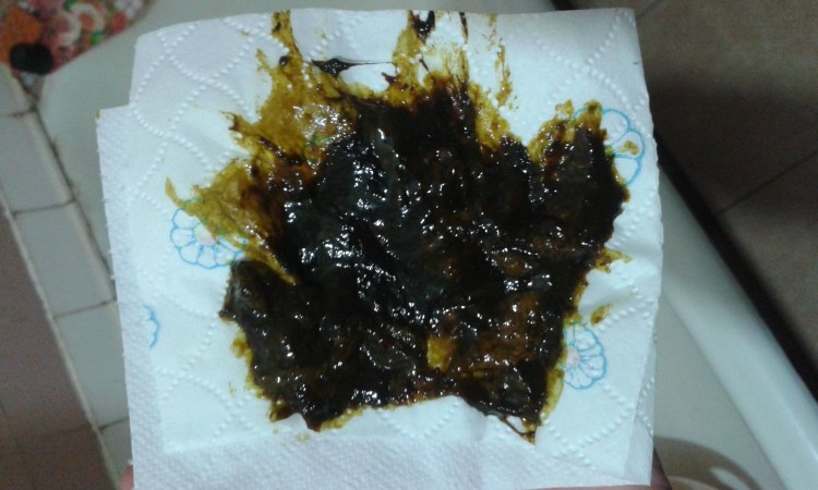 Жидкий стул с глистами