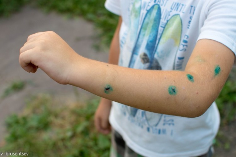 Стригущий лишай (дерматофитоз