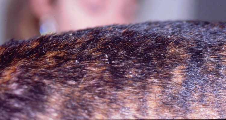 Хейлетиеллез (отрубевидная чесотка)