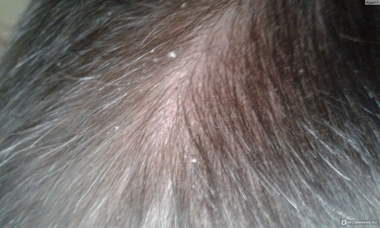 Блошиный дерматит у кошек