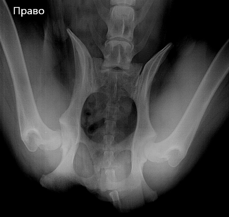 Метафизарная хондродисплазия дисплазии