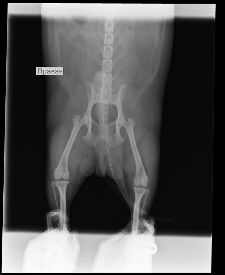 Врождённый вывих бедра дисплазия