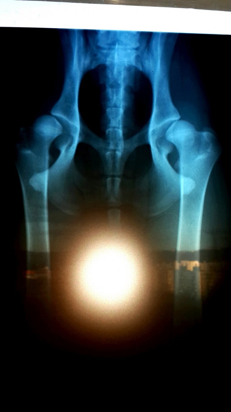 Гемимелическая эпифизарная дисплазия