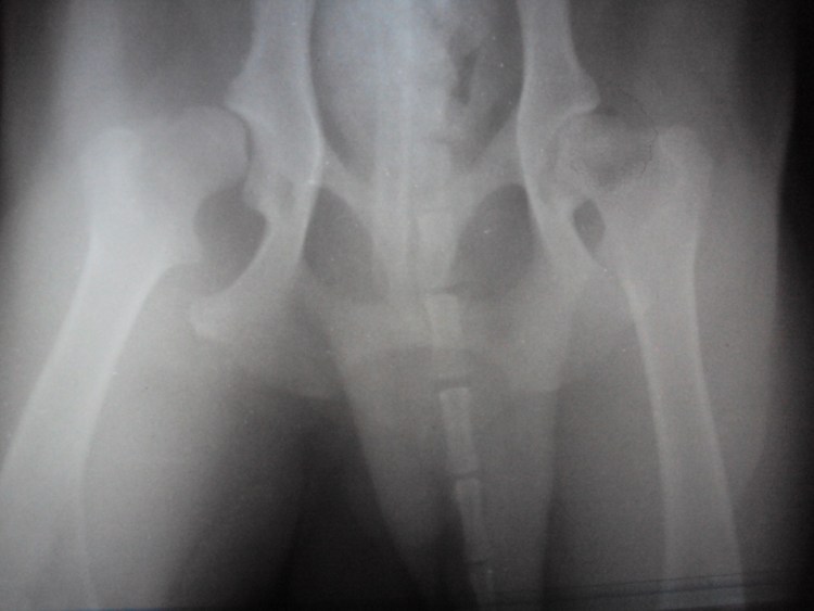 Подвывих тазобедренного сустава рентген