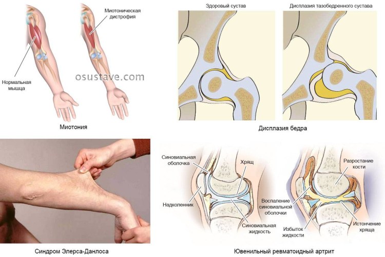 Анатомия вертлужной впадины тазобедренного сустава