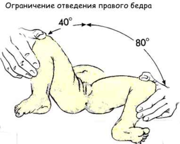 Дисплазия тазобедренных суставов таблица