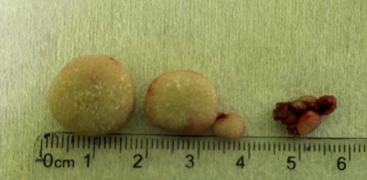 Мочекаменная болезнь УЗИ заключение