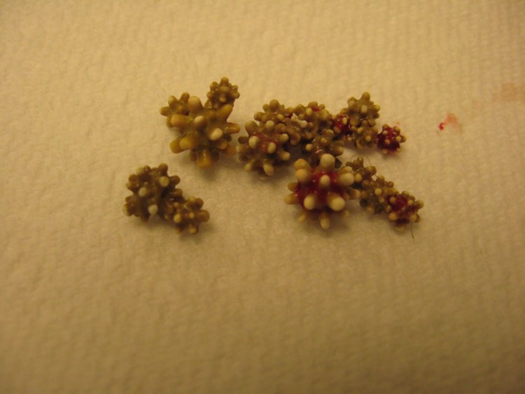 Камни из мочевой кислоты