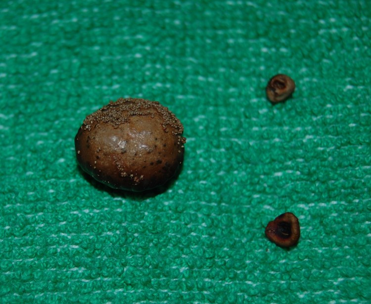 Образование камней в мочевыделительной системе