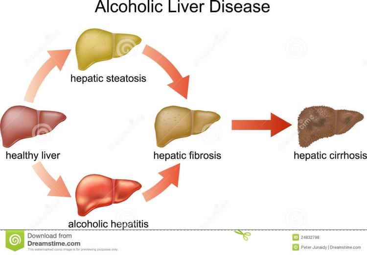 Фиброзный цирроз печени